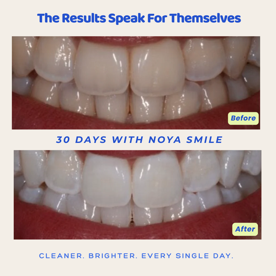 Noya Smile 360° — Hands-Free Sonic Toothbrush