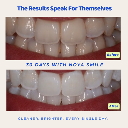 Noya Smile 360° — Hands-Free Sonic Toothbrush